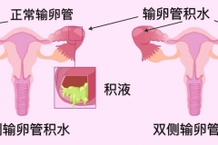输卵管积水对生育影响及治疗方法的利与弊